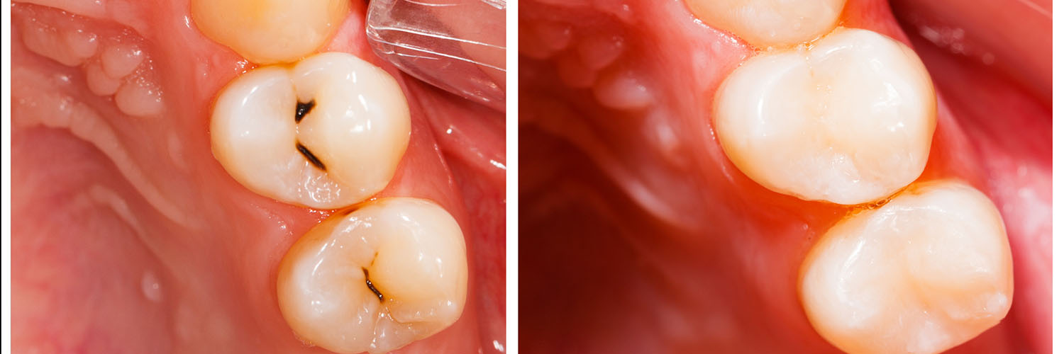 Artistic Family Dental | Intraoral Camera, Dentures and Fluoride Treatment